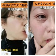 42岁女子20天“断崖式衰老”，真凶竟是卵巢早衰！